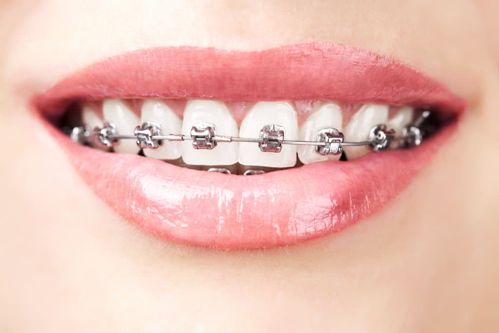 Dental Braces and Orthodontics in Canada Corner Nashik