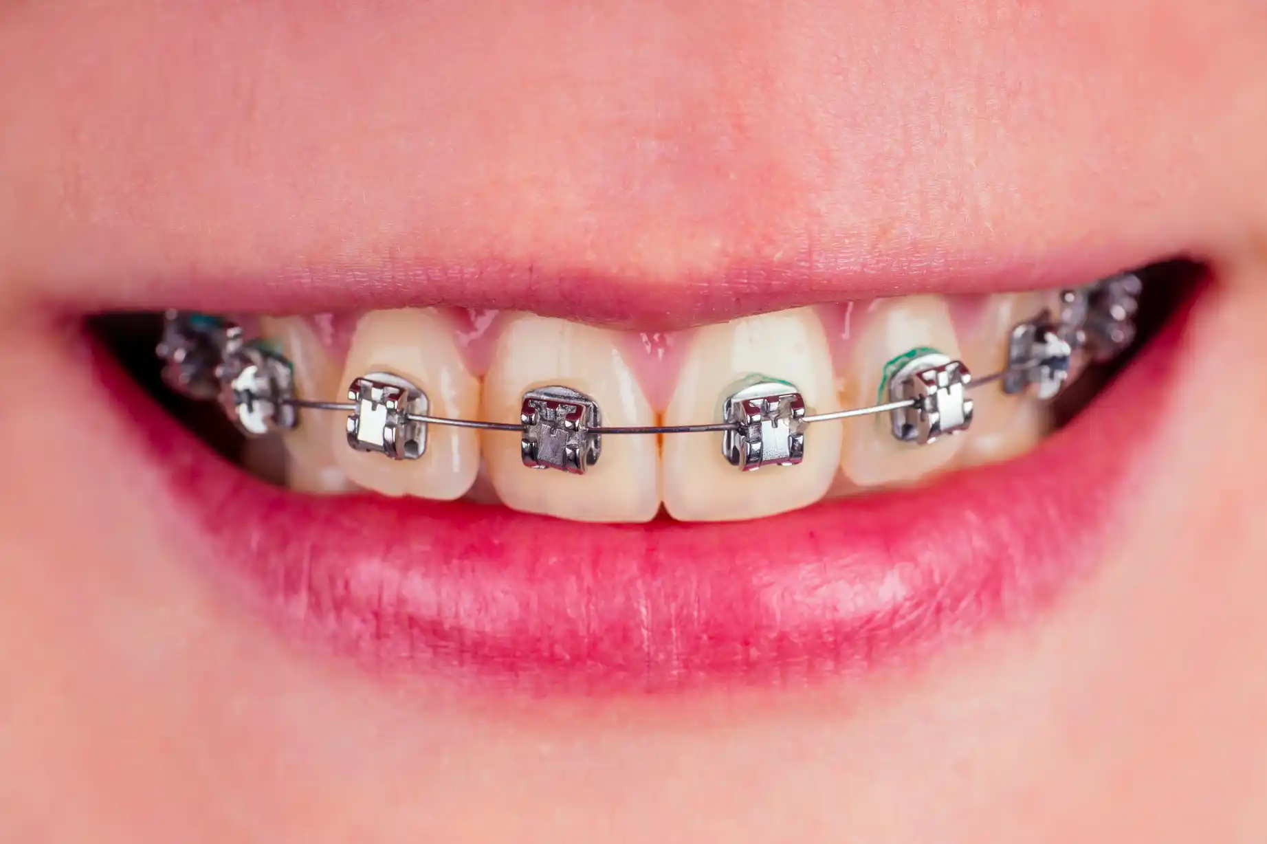 Dental Braces and Orthodontics in Sharanpur Road Nashik