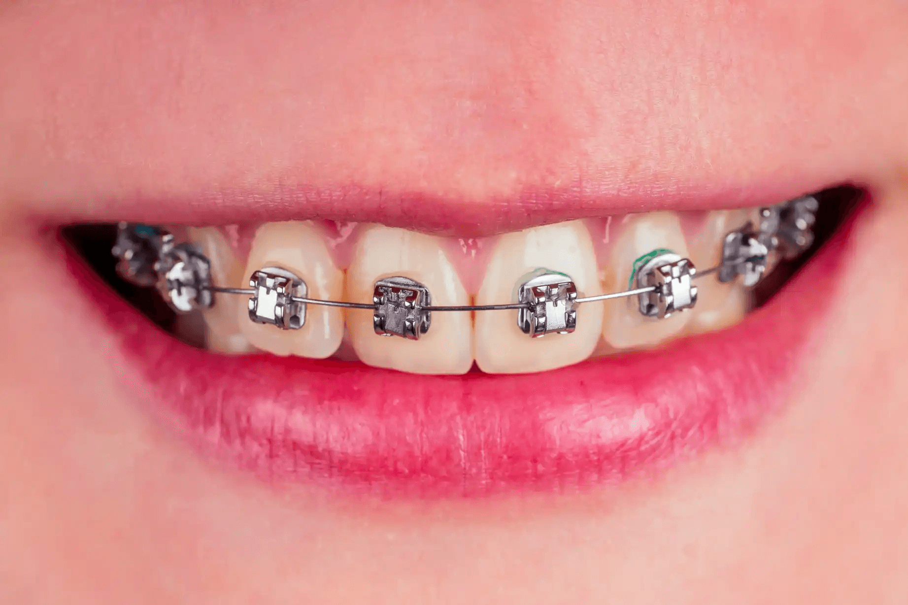 Dental Braces & Orthodontics Clinic in Panchavati Nashik | Care 32