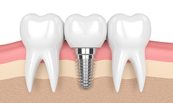 Dental Implant Clinic Near College Road Nashik – Care 32