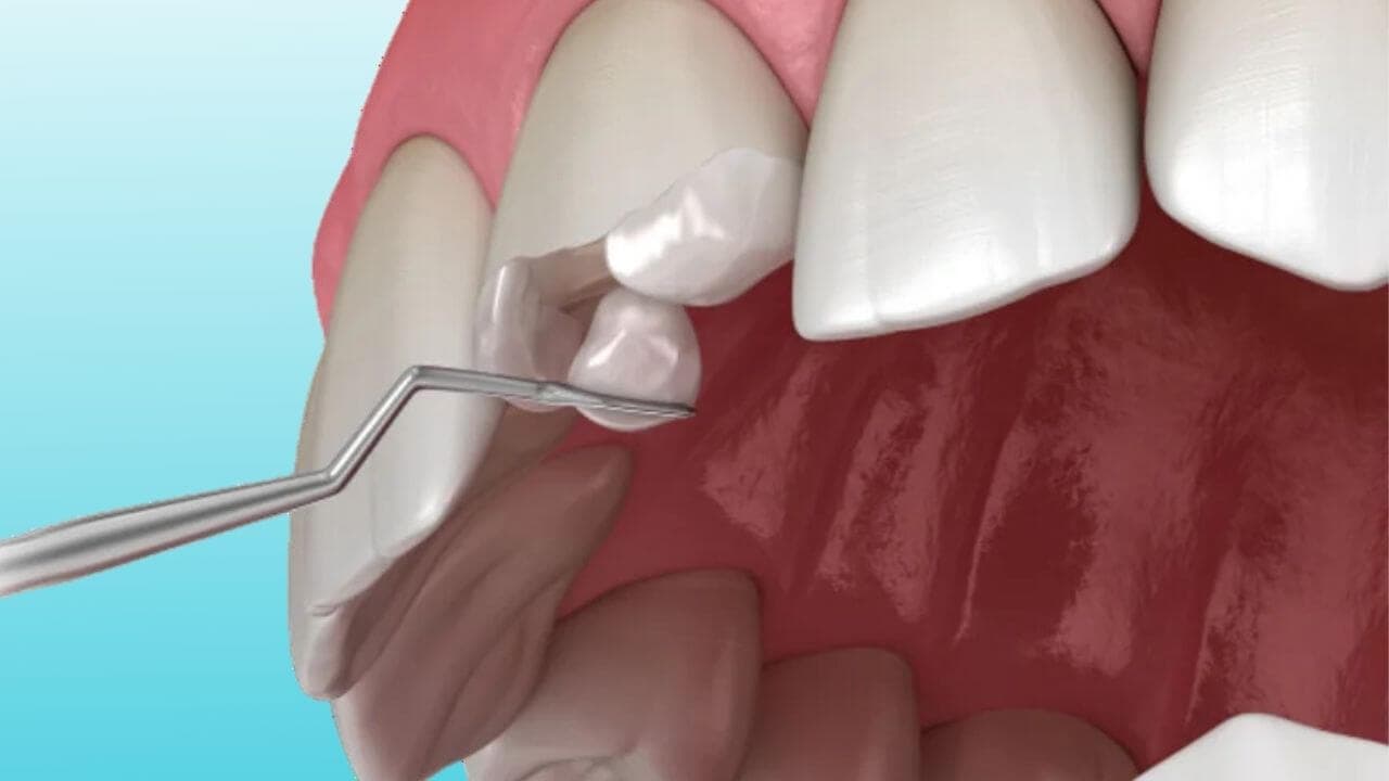 Dental Implants in Nashik | Care 32 Dental and Implant Centre