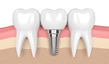 Dental Implants near Gangapur Road Nashik | Care 32 Dental and Implant Centre