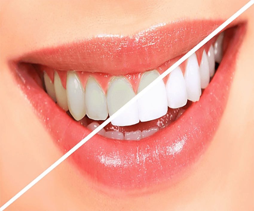 Teeth Whitening in Mahatma Nagar Nashik