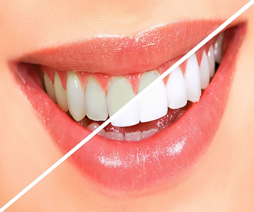 Teeth Whitening in Mahatma Nagar Nashik