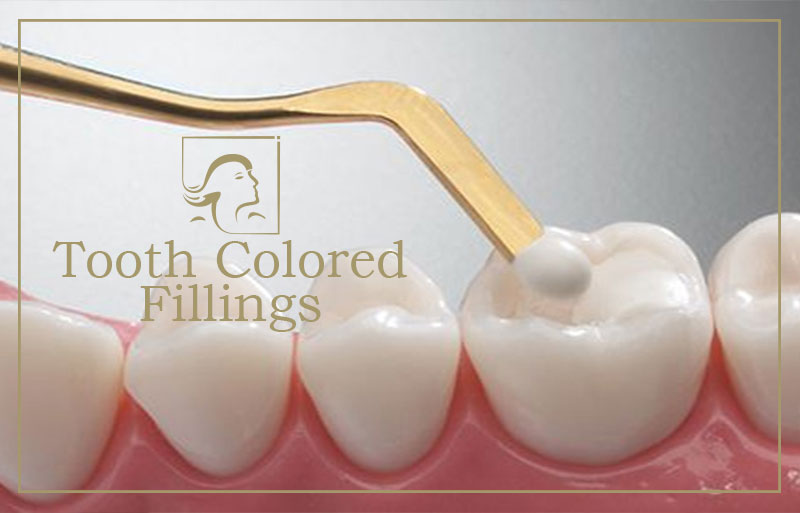 Tooth Color Filling in Mahatma Nagar Nashik - Dental Clinic