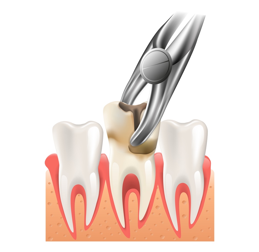 Tooth Extractions in Sharanpur Road Nashik